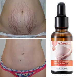 Oem Odm Private Label Veganistische Anti Postpartum Diepe Acne Striae Verwijderen Versteviging Verwijdert Litteken Postpartum Stretch Mark Olie