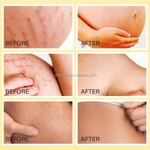 Krim penghilang Stretch mark dan bekas luka untuk kehamilan-perbaikan bekas luka, pengencang perut - Product Image 5