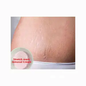 Reduce Anti Pregcy Stretch Marks Pregt Belly Sheet Mask Stretch Marks Removal Cream