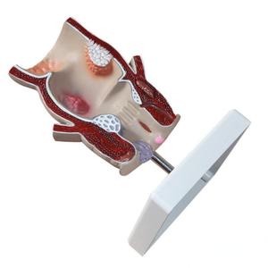 Medizinisches Lehr modell Rektales Pathologie modell für die Ausbildung von Prokto logie und Anatomie - Product Image 6