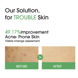 Toallitas Faciales de Árbol de Té con <span class=keywords><strong>Lactobacillus</strong></span> OEM - Calmante y Suavizante para Piel Sensible Propensa al Acné, Mascarilla Facial Hipoalergénica - Product Image 4