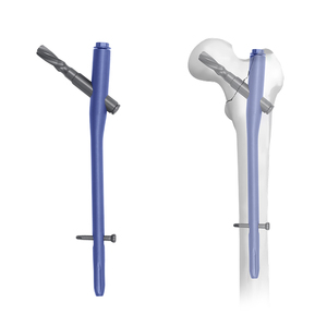 PFNA Intramedullary Nail System for Femur <strong>Fracture</strong>, Proximal <strong>Femoral</strong> Nail Antirotation for Orthopedic Trauma Surgery - Product Image 1