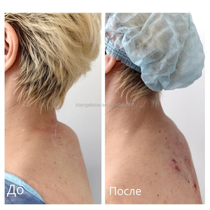 Fiberlift 1470nm <span class=keywords><strong>lipolyse</strong></span> lifting du visage Machine Diode <span class=keywords><strong>Laser</strong></span> liposuccion Endolaser rajeunissement de la peau <span class=keywords><strong>Laser</strong></span> beauté dispositif - Product Image 6