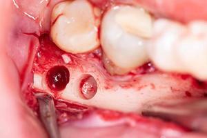 Instrumento de Implante <span class=keywords><strong>Dental</strong></span> para Fragmentos Ósseos e Enxertos Ósseos - Product Image 3