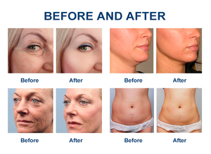 Appareil de beauté ultrasonique 5 en 1 pour le lifting du visage, le remodelage corporel, le resserrement vaginal, l'élimination des rides, le lifting du visage, brosse de nettoyage du visage - Product Image 6