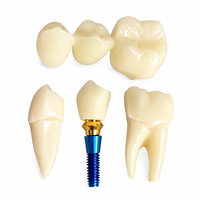 Modèle d'implant dentaire pédagogique, modèle détachable de couronne dentaire et de visqueuse pour la formation des dentistes et l'affichage en clinique