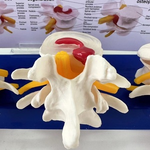 แบบจำลองการบีบอัดหมอนรองกระดูกที่แตกหักแบบสี่ขั้นตอน ตั้งแต่สุขภาพดีไปจนถึงภาวะหมอนรองกระดูกที่แตกหัก - Product Image 2