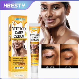 Ungüento para Eliminar Efectivamente el Vitiligo, Elimina la Tiña y las Manchas Blancas, Producto para el Cuidado de la Piel con Vitiligo - Product Image 3