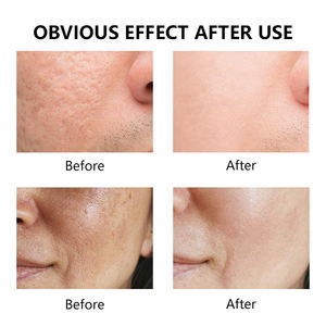 Sérum d'arbre à thé de marque privée formule <span class=keywords><strong>pour</strong></span> peau claire <span class=keywords><strong>pour</strong></span> peau sèche dissolvant efficace de <span class=keywords><strong>boutons</strong></span> d'acné rétrécissement des pores caractéristique cible faciale - Product Image 5