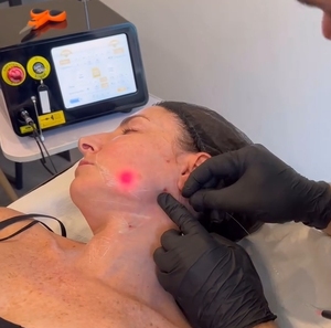 Endoláser Facial Vaser para Liposucción, Dispositivo de Estiramiento Facial, Cánula Endoláser 1470 - Product Image 1