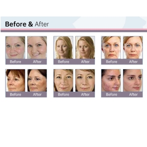 Hydro Facial Machine Deep Cleaning Exfoliating Shrink Pores Skin Young Hydro Beauty Machine - Product Image 5