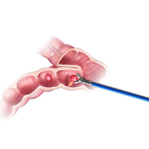 Pinça de Biópsia Oval com Ponta Espinhosa Não Revestida para Colonoscopia, Diâmetro Externo 2,4mm, Comprimento 2300mm, para Dispositivos Médicos - Product Image 6