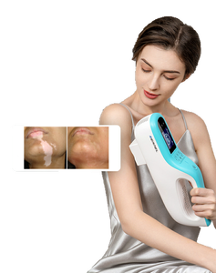 308nm UVB Fototerapia Excimer Láser Vitiligo Psoriasis Lámpara Uv Fototerapia Terapia de luz Tratamiento de vitiligo en el hogar - Product Image 3