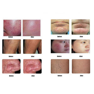 980nm Diodo Laser Máquina Aranha Veia Remoção Vascular UK Plug Desktop Modelo Pele Clareamento Apertando Face Lift Face Tratamentos - Product Image 3