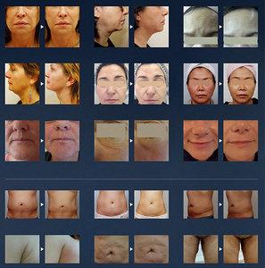 Máquina de Adelgazamiento Liposonic 8D Hifu, Contorno Corporal, Reducción de Grasa, Reafirmación de la Piel, Equipo de Belleza Facial - Product Image 6