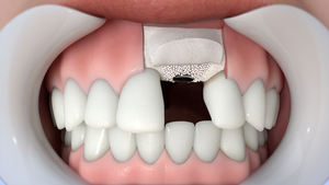 Membrana orale del collagene impianto dentale Sterile del dente dello strato del collagene dentale - Product Image 6