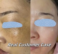 Crème correctrice de taches à la niacinamide en gros pour les taches noires, l'hyperpigmentation, l'éclaircissement, l'élimination des taches de rousseur et la correction des cicatrices d'acné