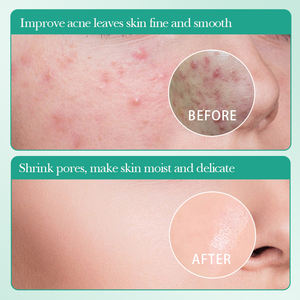 OEM SADOER masker Label pribadi, perawatan wajah lembar asam salisilat pelembab tiga langkah - Product Image 4