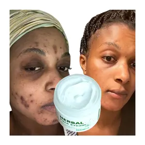 Crema cosmetica Anti-Acne per il viso con cicatrice per i brufoli cura della pelle lenisce idratare la pelle esfoliante per l'invecchiamento e ritardare la crema per il viso a base di erbe
