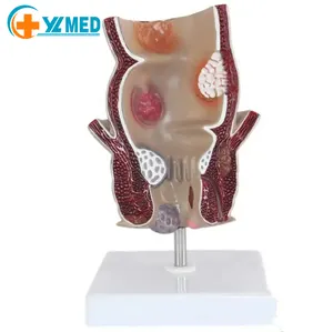 Medical teaching Used for teaching enlarged display of anorectal acne pathological model rectal intestinal anatomical model
