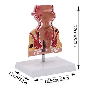 แบบจำลองลำไส้ใหญ่ของมนุษย์ แบบจำลองริดสีดวงทวาร แบบจำลองริดสีดวงทวารภูมิภาคนะวัตถุวิทยา แบบจำลองรูรั้วทวารหนัก แบบจำลองทางกายวิภาค - Product Image 3