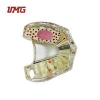 Modèle d'implant dentaire anatomique en résine (UM-2007) - Demi-jeu supérieur avec carie, fracture de la racine et kyste, en résine durable