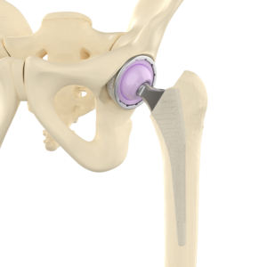 Prostesis Sendi Penggantian Pinggul <span class=keywords><strong>Total</strong></span> Parsial Dual Mobility Artroplasti dengan Cup Acetabular Bersemen Primer UHMWPE Kelas CE III 5+ - Product Image 3