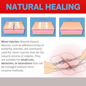 Cierre de heridas con cremallera médica Zip Stitch, marca privada, para ataduras, dispositivo de emergencia, 2 unidades, suturas, tira de cierre de heridas - Product Image 4