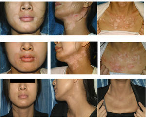 Toàn Bộ Cơ Thể 311nm Hẹp <span class=keywords><strong>UVB</strong></span> Đèn Chiếu Đèn UV Cho Bệnh Vẩy Nến Bệnh Bạch Biến Điều Trị - Product Image 5