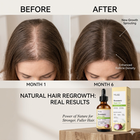 Aceite Natural de Romero y Cebolla con Biotina para el Crecimiento Rápido del Cabello, Tratamiento Anticaída, Suero para el Cuero Cabelludo, para Hombres y Mujeres