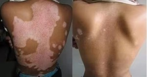 Cabine UV Kernel avec 40 tubes spéciaux <span class=keywords><strong>311NM</strong></span> NB UVB PUVA, cabine de photothérapie pour le traitement complet du vitiligo - Product Image 2