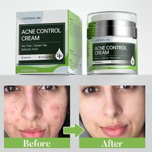 Meilleure crème pour enlever les cicatrices d'acné Crème anti-acné Crème hydratante pour le <span class=keywords><strong>visage</strong></span> Crème organique pour enlever les boutons d'acné - Product Image 2
