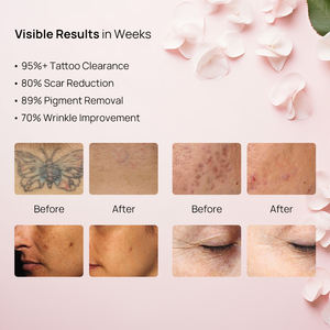 เครื่องเลเซอร์เลเซอร์กำจัดรอยสัก Picosecond ND YAG สวิตช์ Q - Product Image 3