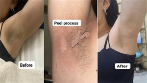 Kit de Biomicroneedling GZ aux Spicules de Spongilla, <span class=keywords><strong>Bio</strong></span> Peeling Cutané Non Chimique, Bioneedling Sûr pour Tous Types de Peaux, Kit de Peeling Cutané - Product Image 5