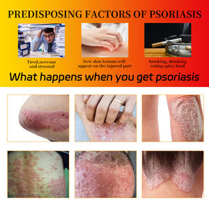 ZuLangZhong противогрибковая Антибактериальная мазь для кожи, 15 г - Product Image 4