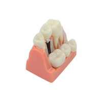 Modèle d'implant dentaire Éducation du patient Modèle dentaire Anatomie des dents Implant Couronne Pont Modèle de formation dentaire