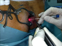 Laser de proctologie approuvé par les États-Unis pour le traitement des hémorroïdes, haute puissance 47W 1470nm GiAIAs, laser chirurgical anorectal