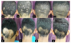 Tốt nhất bán y tế CE USA 510K <span class=keywords><strong>UVB</strong></span> quang trị liệu 308nm excimer <span class=keywords><strong>UVB</strong></span> ánh sáng 308nm bệnh vẩy nến vitiligo máy laser KN-5000C - Product Image 3