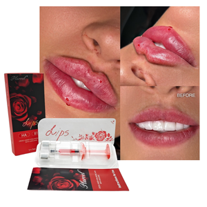 Lot de 1 ml – <span class=keywords><strong>Injection</strong></span> pour lèvres rouges – Acide hyaluronique – Remplisseur dermique – Sérum injectable VB12 pour éclaircir la couleur des lèvres – 1 ml - Product Image 2