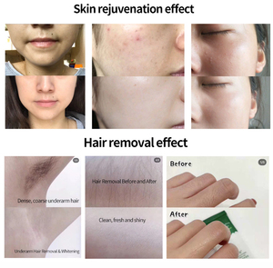 Nouvelle arrivée, appareil d'épilation DPL, masque de rajeunissement de la peau, type 2 en 1, système de refroidissement à eau, portable - Product Image 5