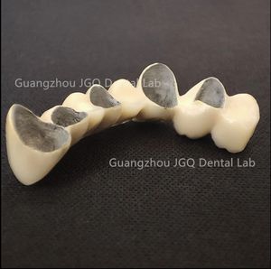 พอร์ซเลนหลอมรวมกับฟันปลอมโลหะ (โลหะผสมโครเมี่ยมโคบอลต์) - Product Image 3