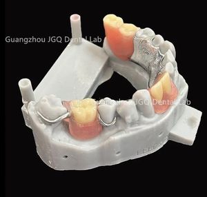 Prothèses dentaires amovibles avec cadre métallique en alliage de cobalt-chrome bonne biocompatibilité pour les humains de laboratoire dentaire de Chine prix bon marché - Product Image 6