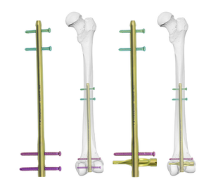 Distal Femur <strong>Nail</strong> for Fracture <strong>Fixation</strong> <strong>Intramedullary</strong> <strong>Nail</strong> System for Supracondylar and Femoral Shaft Fractures Titanium - Product Image 1