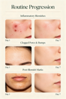 Krim Jerawat Herbal Alami Grosir Label Pribadi Krim Noda Botani Kulit Pohon Willow Putih Semua Jenis Kulit Vegan Melembapkan
