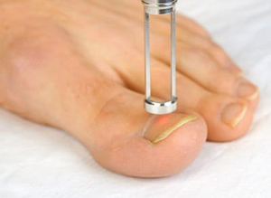 Dispositivo de tratamiento láser de hongos en las uñas de los pies tratamiento de hongos láser para uñas de los pies uso profesional podólogo - Product Image 6