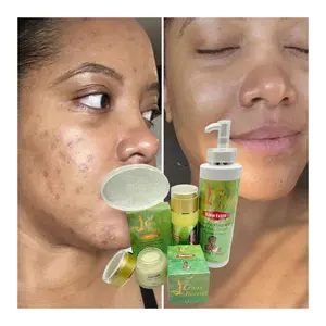 OEM do your logo treat acne and post-acne marks on dark skin remove blemishes lighten clarify skin glow and tone skincare lines