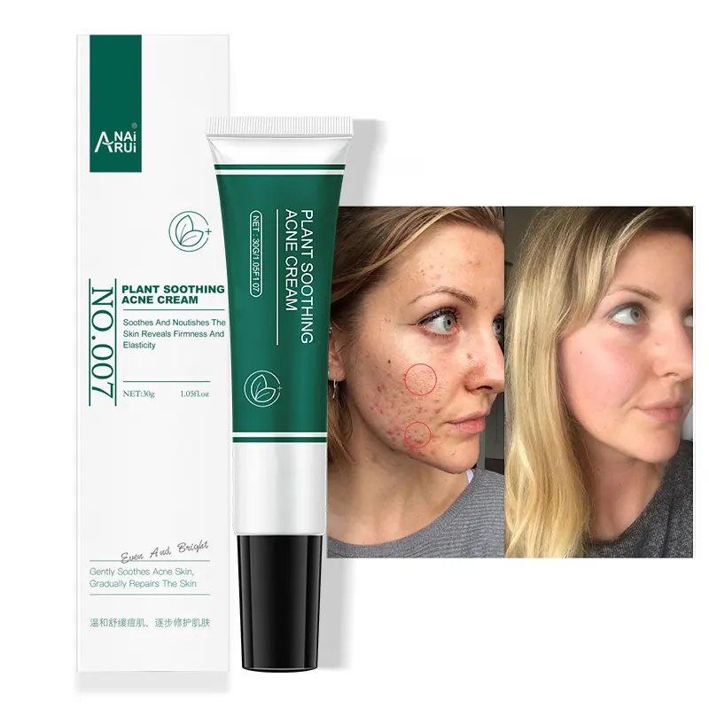 Creme de remoção de acne do oem, creme profissional de tratamento de acne do purslane, extrato natural de planta