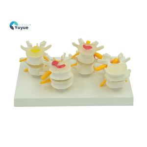 Lesione della colonna lombare a quattro stadi modello anatomico per l'educazione medica - Product Image 5