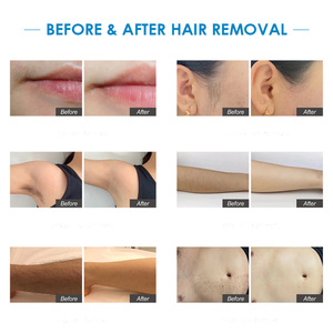 Eos ICE <strong>2026</strong> Hair Remover <strong>Laser</strong> Diodo 3 Wavelength 3D Skin Analysis 3 Wavelength <strong>Laser</strong> Professional Diode <strong>Laser</strong> Hair Removal - Product Image 5