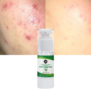 Oem/ODM nhãn hiệu riêng cây trà nổi mụn đốm đen Remover vết sẹo làm sạch sâu mặt chăm sóc da sửa chữa mụn Gel Kem - Product Image 2